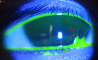 5岁男童眼睫毛“倒着长”专家：这种先天眼病常被家长忽视 母婴健康 第2张