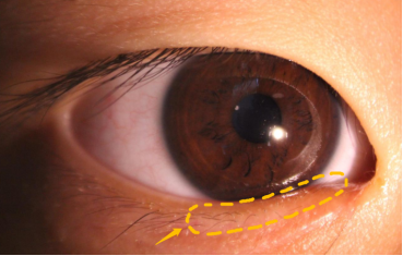 5岁男童眼睫毛“倒着长”专家：这种先天眼病常被家长忽视 母婴健康 第3张