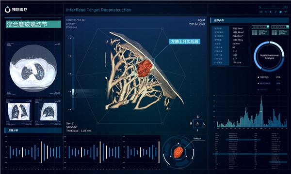 肺结节2.0时代来临：全球首个肺结节AI靶重建产品获NMPA三类证